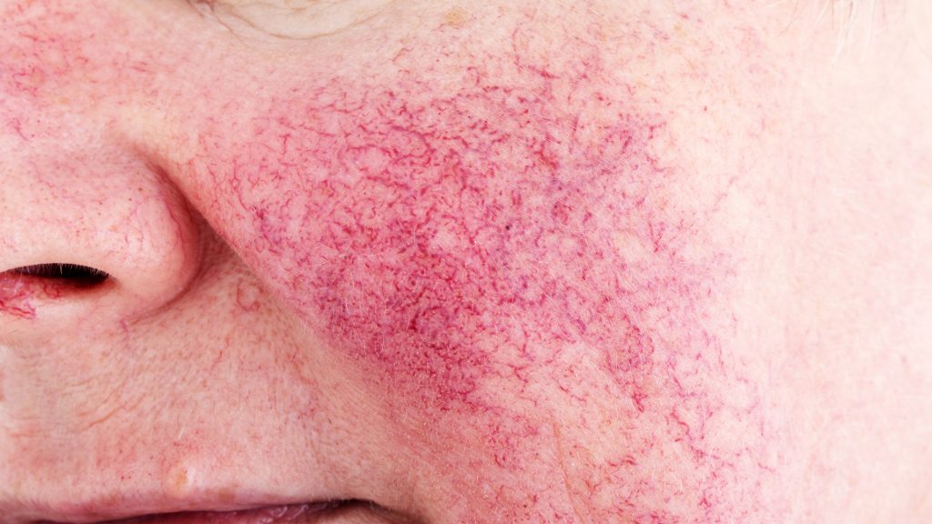 couperose2 couperose2