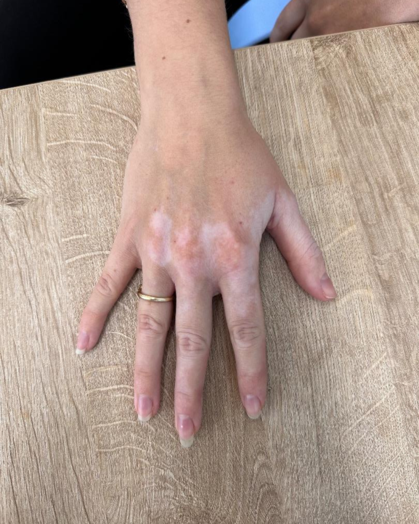 camouflagetherapie foto 2