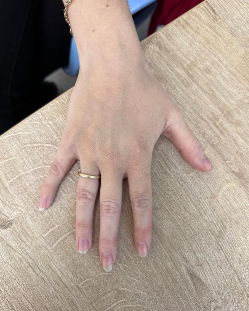 camouflagetherapie foto 3