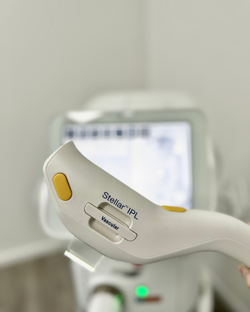 couperose foto 4 couperose foto 4