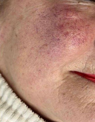 kopie van kopie van kopie van acne in de zomer 5 kopie van kopie van kopie van acne in de zomer 5