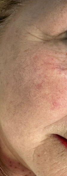 kopie van kopie van kopie van acne in de zomer 5 kopie van kopie van kopie van acne in de zomer 5