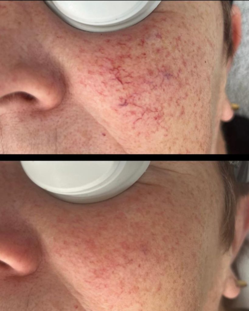 couperose meer informatie couperose meer informatie