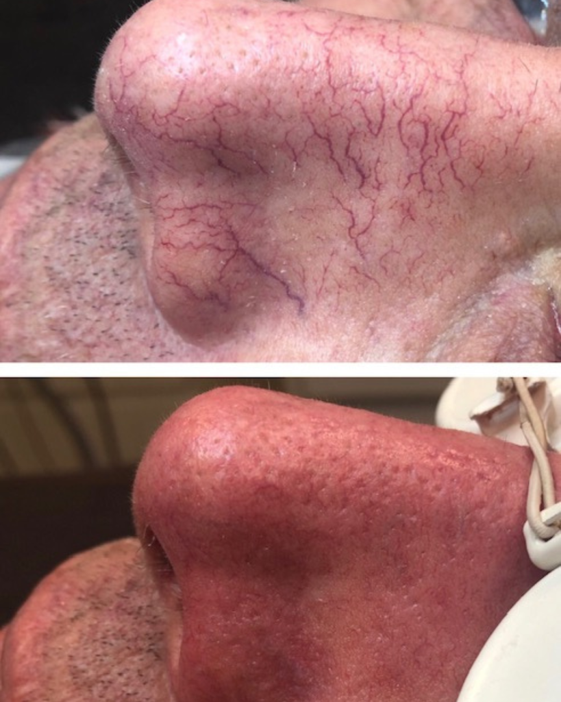 vaatlaser 2 of 4 ik weet niet of we hier al een voor en na foto hebben maar anders deze als laatste foto